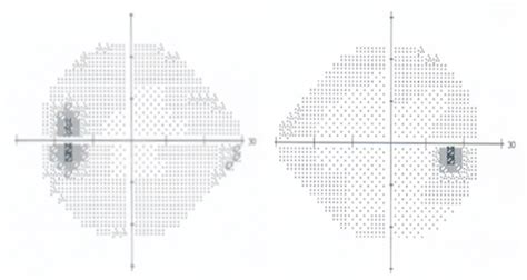 blind spot test normal results|Visual Field Test: What It Is and What the Results Mean.